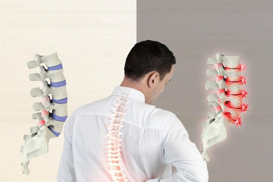 Thoái hóa khớp: Phòng bệnh để giảm gánh nặng cho xương khớp