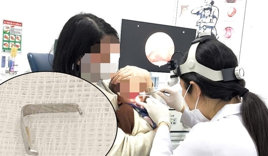 Cấp cứu bé trai bị ghim sắc nhọn mắc trong họng