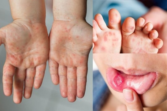 Xã Tây Phương ghi nhận 12 ca mắc bệnh tay chân miệng