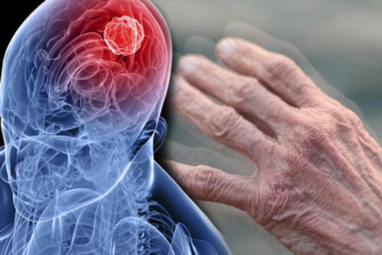 Nam và nữ mắc Parkinson biểu hiện sớm khác nhau ra sao?
