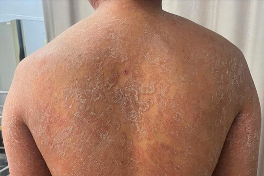 Nấm da lan khắp cơ thể vì tự mua thuốc bôi