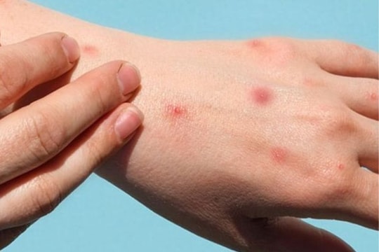 Nuôi thú cưng, cảnh giác sẩn ngứa do bọ chét