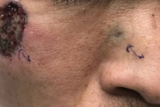 Tái sinh nụ cười sau ca phẫu thuật ung thư da vùng mũi
