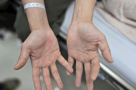 "Bóng cười" và cái giá đắt sau những cuộc vui ngắn ngủi