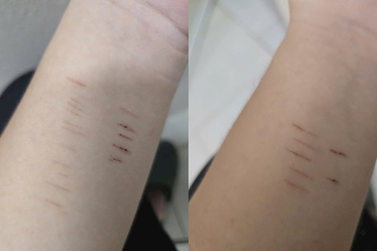 Trẻ có biểu hiện tự hại, cha mẹ phải làm gì?