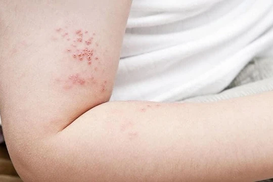 Bác sĩ tại nhà Nhận biết và điều trị tổn thương do zona thần kinh