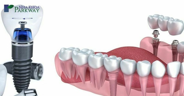 Thủ tục và chi phí trồng răng implant giá rẻ tại nha khoa ParkWay?
