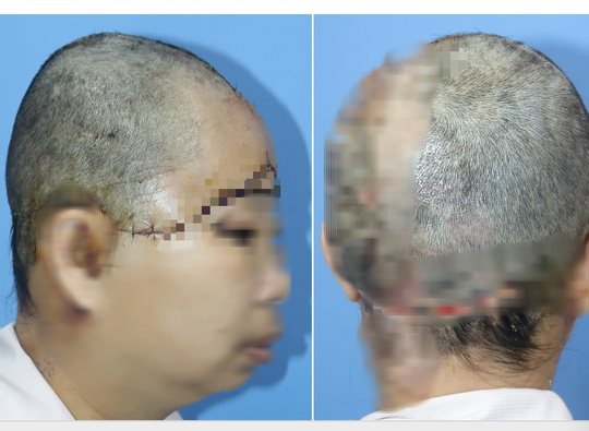 Nối thành công mảnh da đầu bị đứt rời cho một phụ nữ