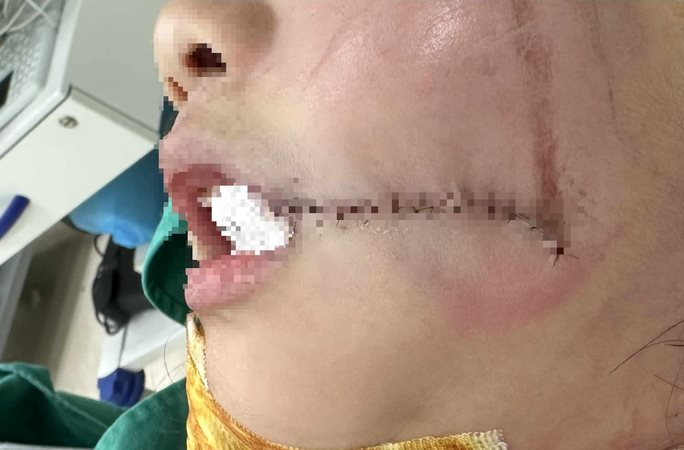 Kẹp đầu vào thang máy, bé gái 7 tuổi bị chấn thương vùng mặt nghiêm trọng