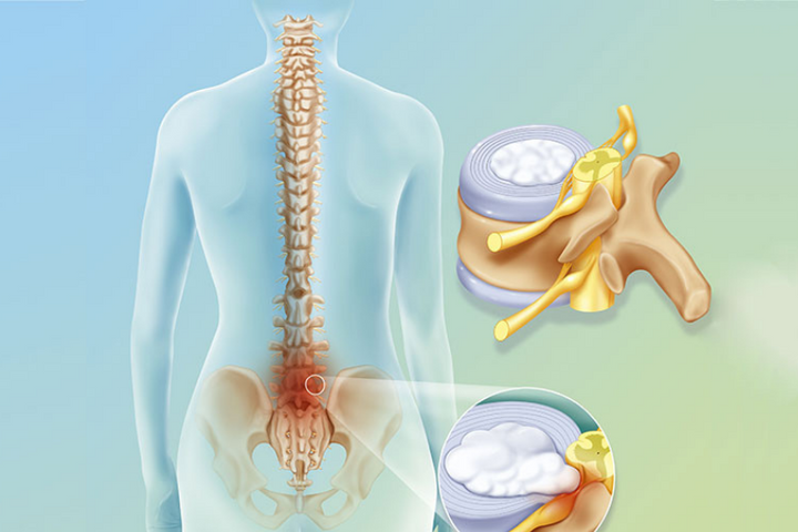 Bệnh thoát vị đĩa đệm có xu hướng “trẻ hóa”