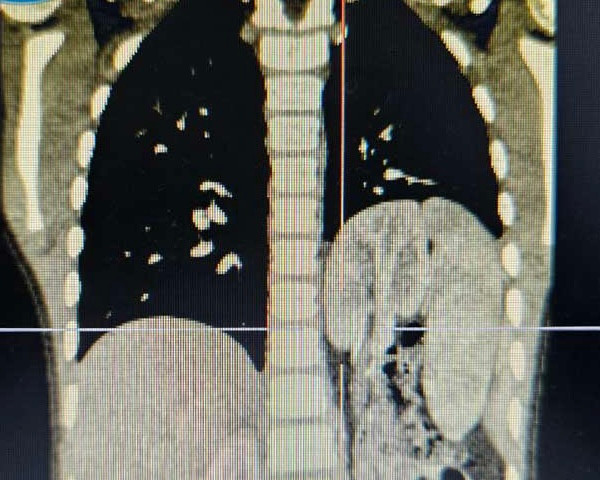 Em bé 6 tuổi ở Hà Nội có thận “lạc chỗ” lên lồng ngực