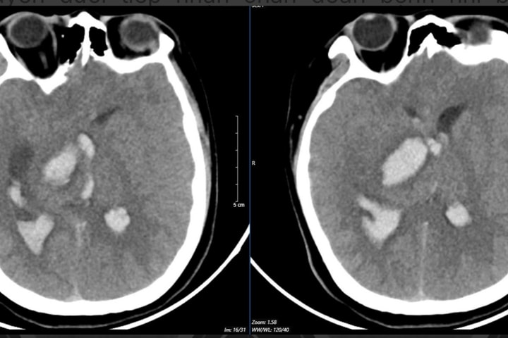 Bé 15 tuổi tử vong sau cơn đau đầu đột ngột