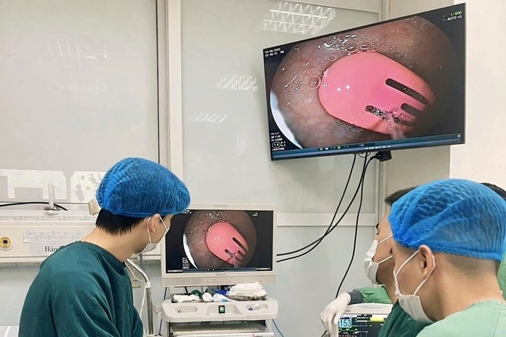 Gắp dị vật là kẹp tóc dài trong dạ dày bé 21 tháng tuổi