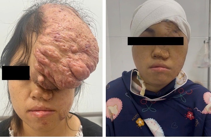 Sở Y tế TP Hồ Chí Minh: Phẫu thuật thành công khối u sụn xương sọ cho bệnh nhân dân tộc Mông