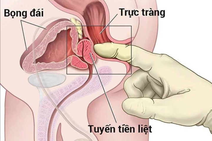 Triệu chứng điển hình của phì đại tuyến tiền liệt