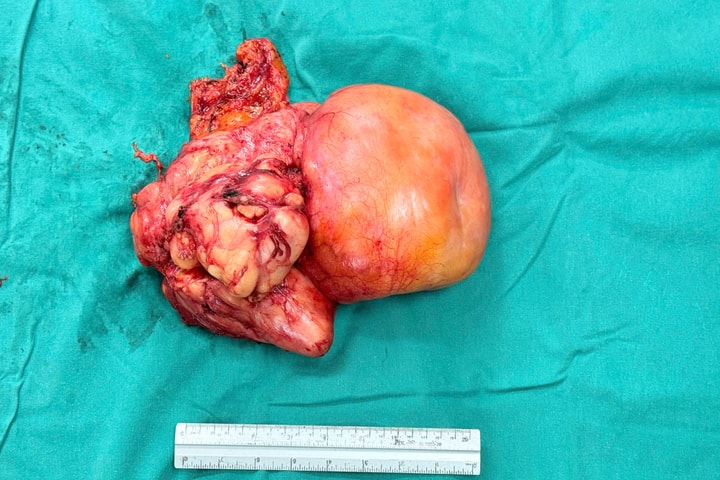 Phẫu thuật cắt bỏ thành công khối u ác tính gần 4kg