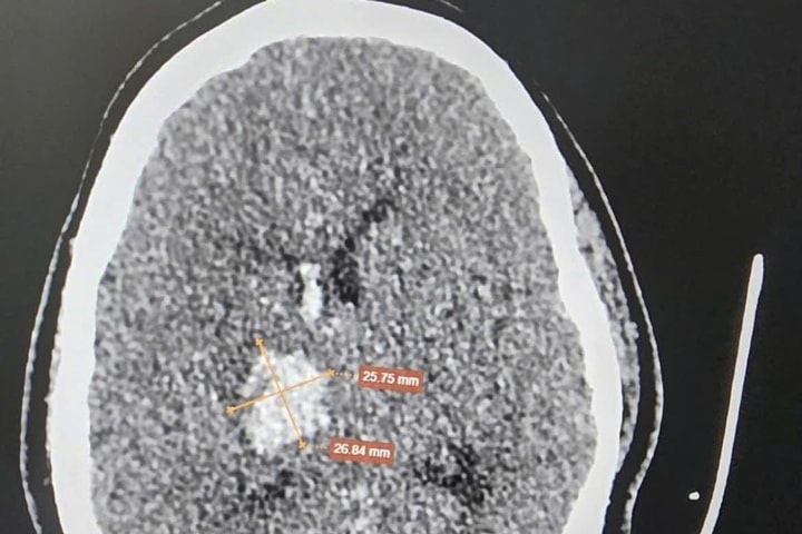 Xử trí thành công một ca hội chứng mạch máu hiếm gặp