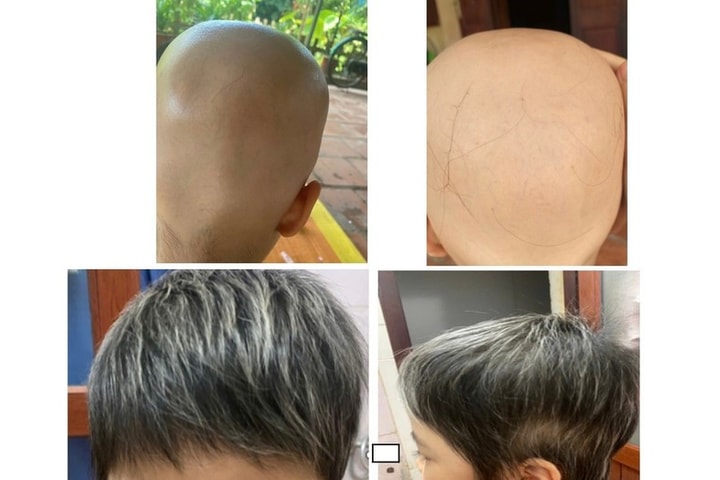 Bé gái 7 tuổi thoát khỏi rụng tóc toàn thể nhờ thuốc ức chế Janus kinase