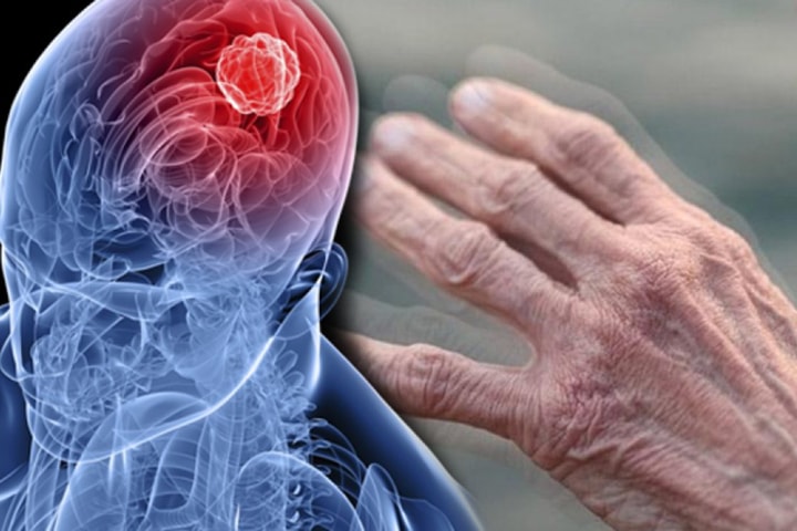Nam và nữ mắc Parkinson biểu hiện sớm khác nhau ra sao?