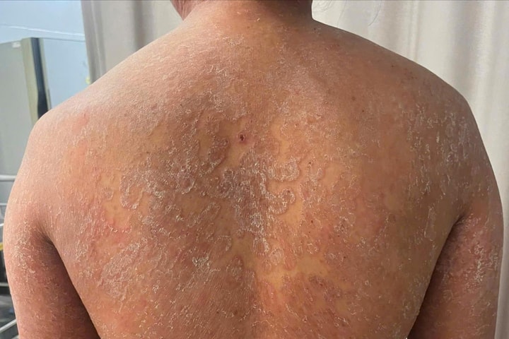Nấm da lan khắp cơ thể vì tự mua thuốc bôi