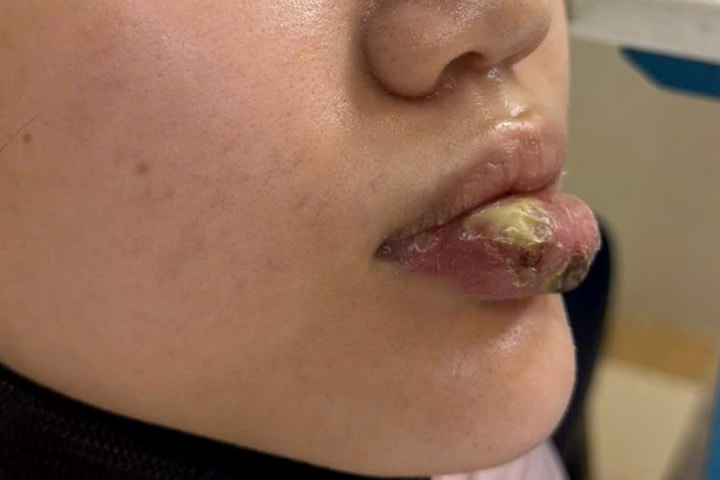 Cảnh báo nhiễm trùng nặng sau tiêm “giải filler” tại cơ sở không phép