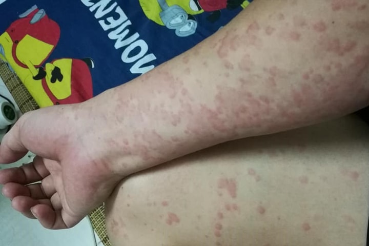 Cảnh giác nguy cơ sốc phản vệ do dị ứng hải sản