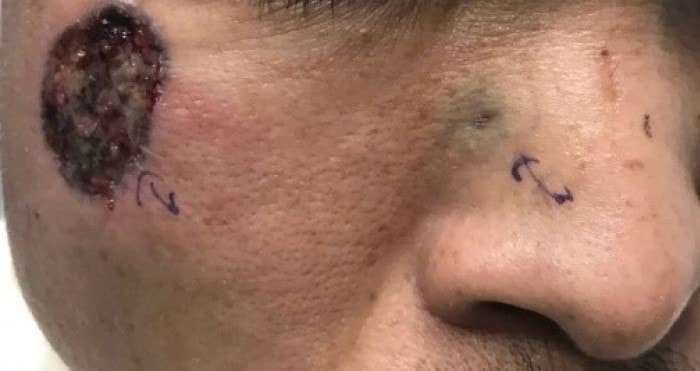 Tái sinh nụ cười sau ca phẫu thuật ung thư da vùng mũi